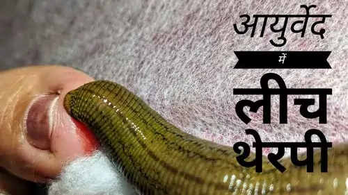 leech therapy in ghaziabad