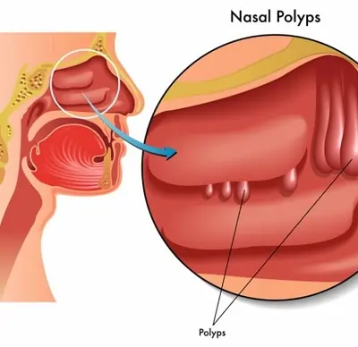 nasal polyp treatment in ghaziabad