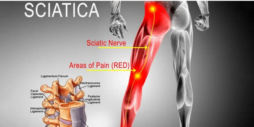 panchkarma tretment for sciatica pain in ghaziabad