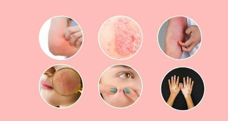 Panchakarma treatment for skin diseases